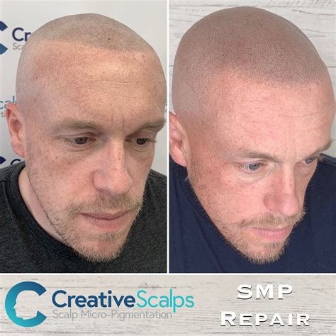 scalp micropigmentation wimbledon